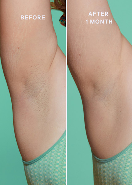 Before and after images of model using ultimate skin solution spray on underarm