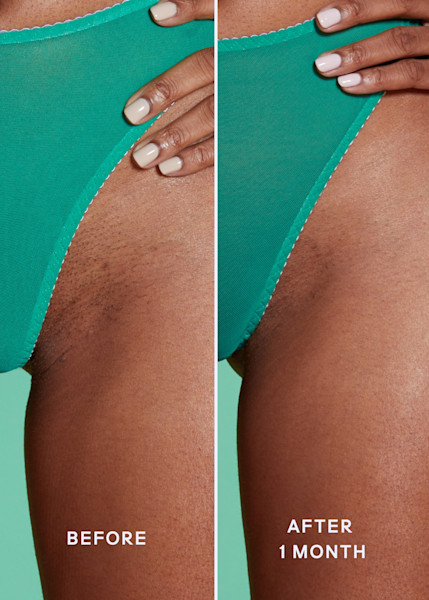 Before and after images of model using ultimate skin solution spray on bikini line