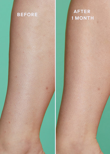 Before and after images of model using ultimate skin solution spray on leg